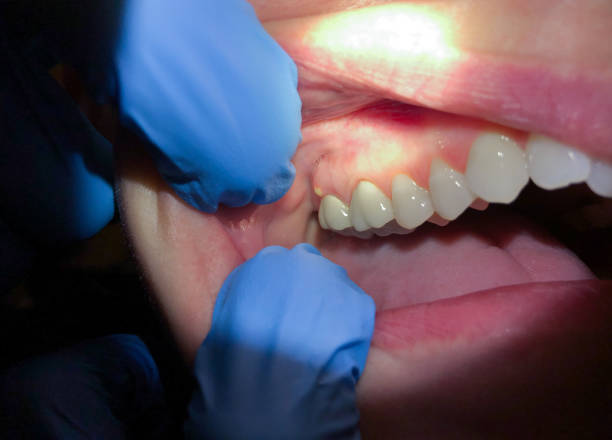 Best Emergency Tooth Extraction in Centerville, GA